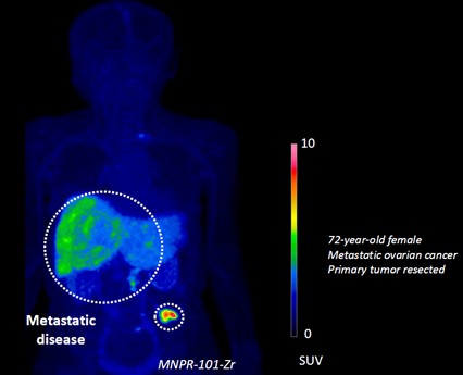 zrovariancancerpatient.jpg