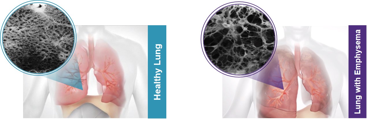 lung-20211231_g1.jpg